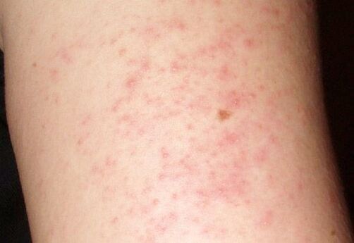 Itchy rashes - a symptom of the presence of worms in the liver